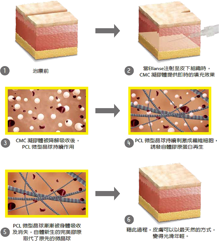 洢蓮絲Ellanse @己研美學診所