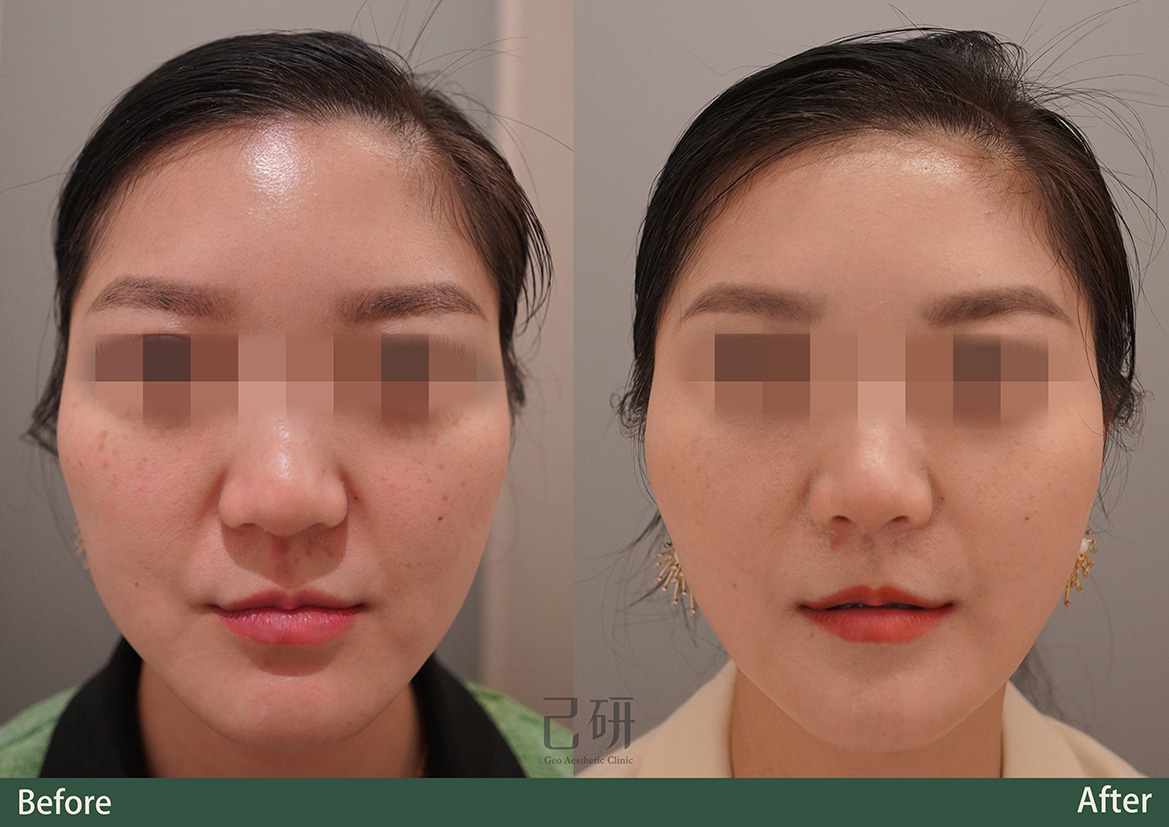 玻尿酸 @己研美學診所