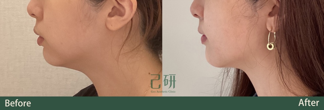 海芙音波Ultraformer lll @己研美學診所