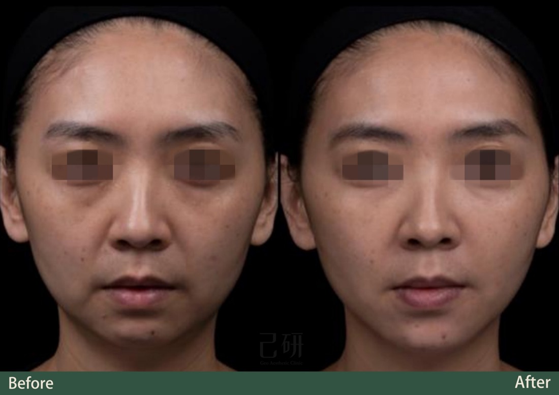 玻尿酸 @己研美學診所