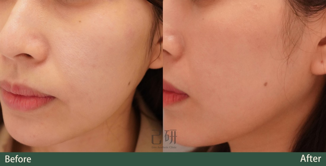 玻尿酸 @己研美學診所