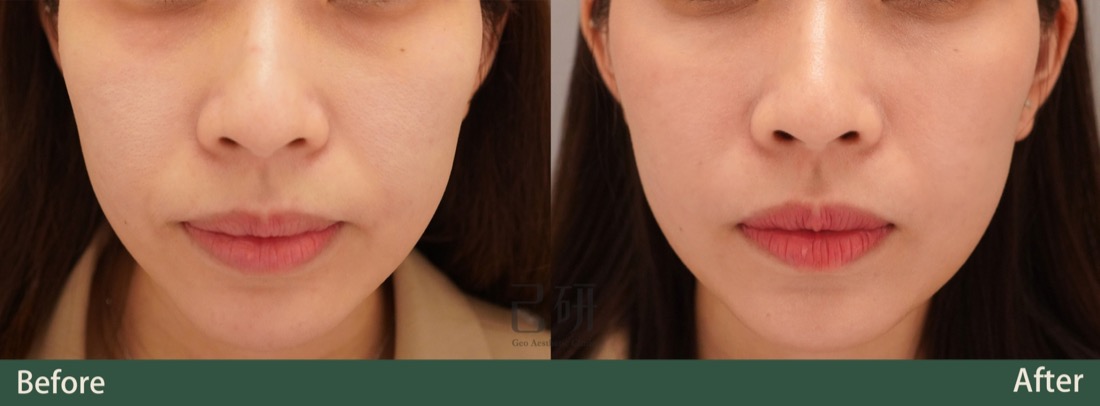 玻尿酸 @己研美學診所