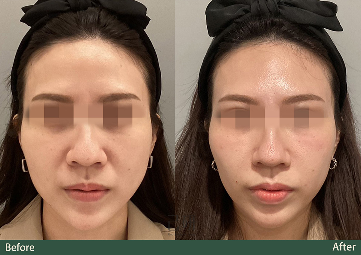 玻尿酸 @己研美學診所