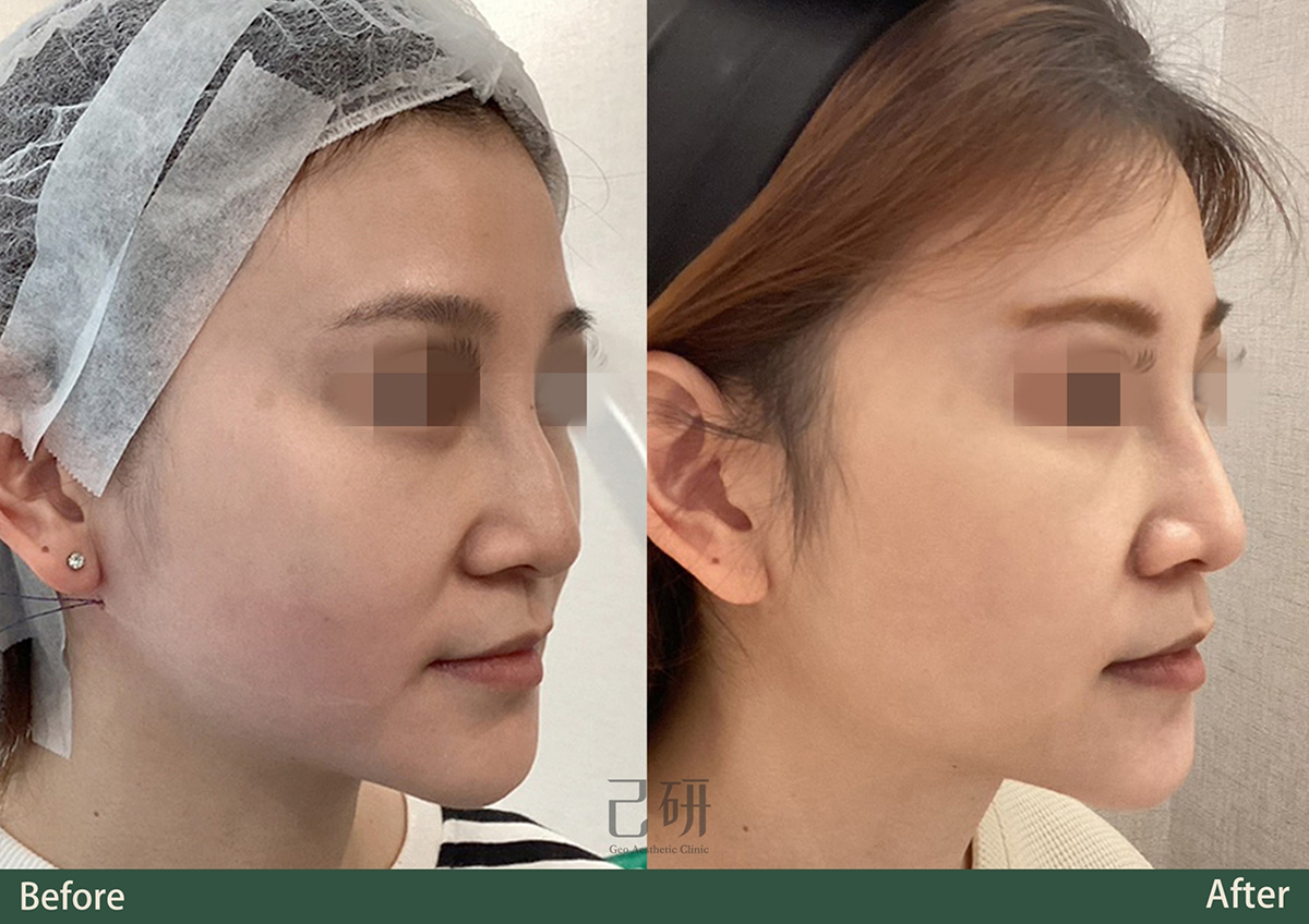 玻尿酸 @己研美學診所