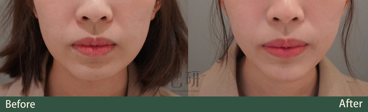 玻尿酸 @己研美學診所