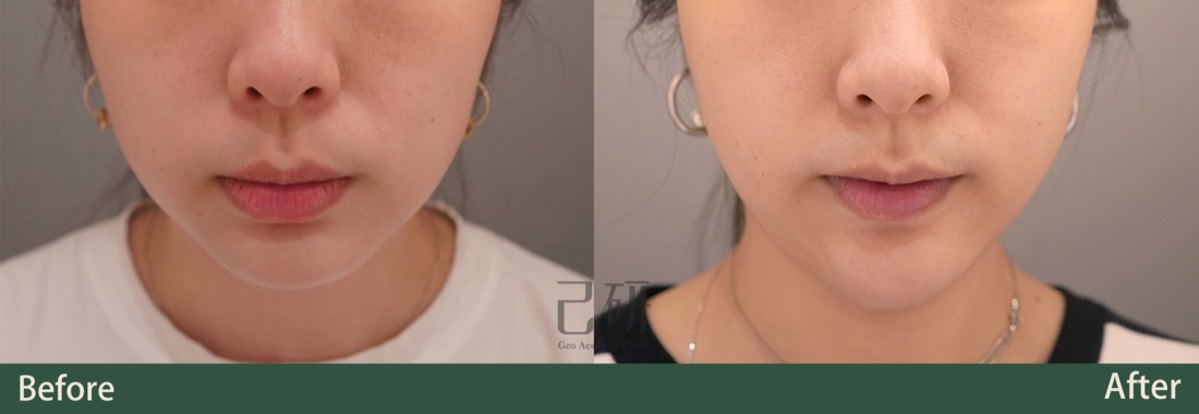 玻尿酸 @己研美學診所