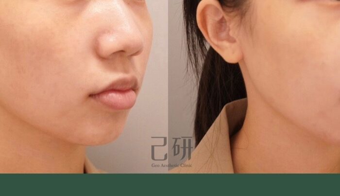 異體真皮粉MegaFill @己研美學診所