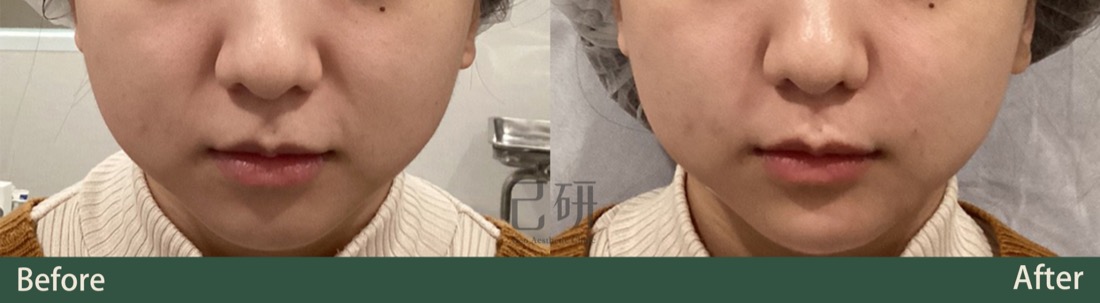 異體真皮粉MegaFill @己研美學診所