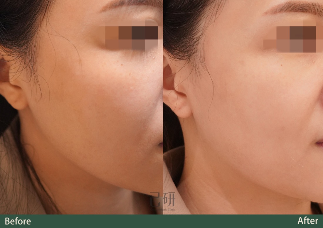 三倍光脈衝光Lumecca @己研美學診所