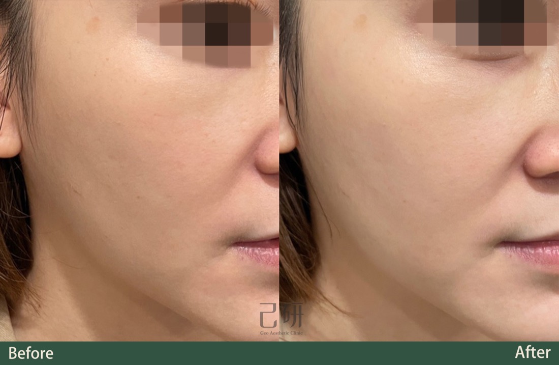 三倍光脈衝光Lumecca @己研美學診所