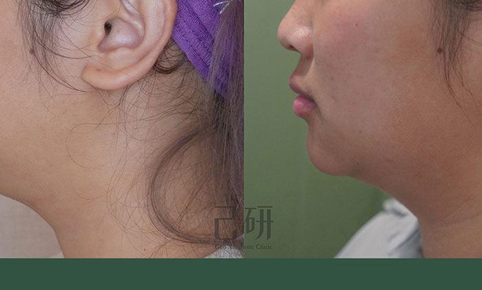 自信見證 @己研美學診所