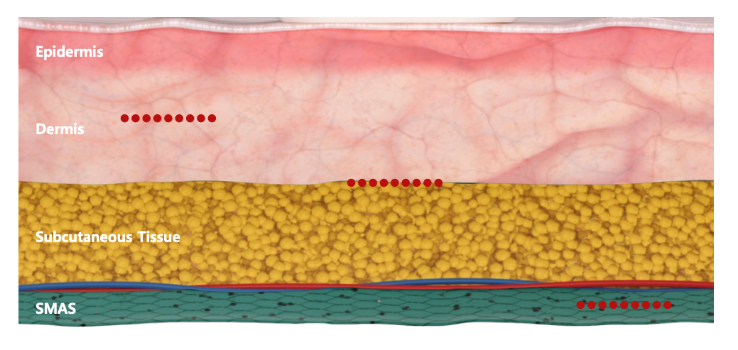 FocusDual閃電微針X閃電音波  @己研美學診所