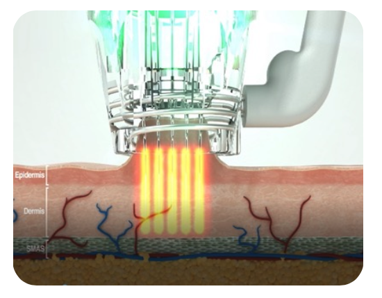 FocusDual閃電微針X閃電音波  @己研美學診所