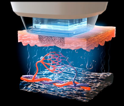 Reepot AI時光雷射 @己研美學診所