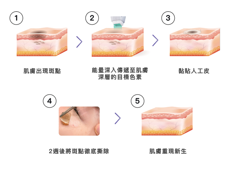 Reepot AI時光雷射 @己研美學診所